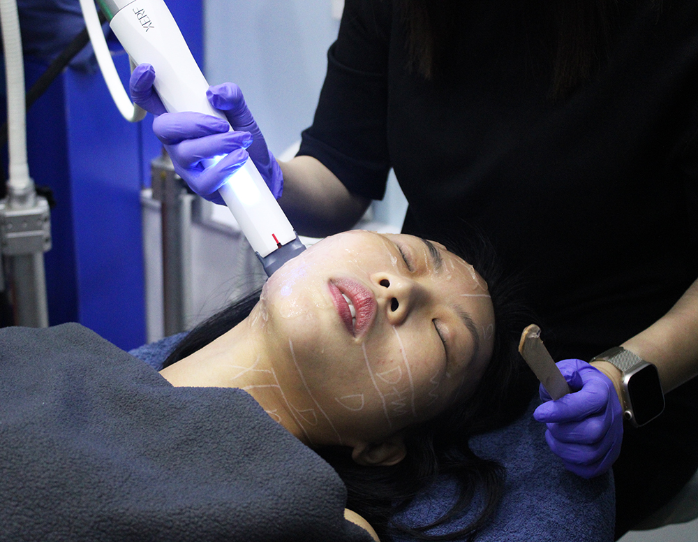 XERF-treatment-in-Singapore