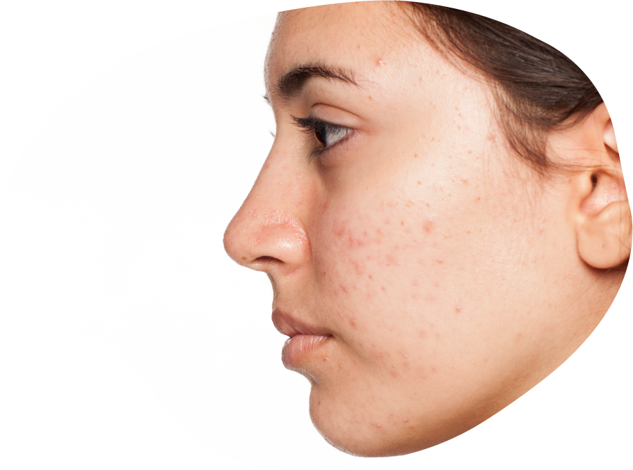 Halley Medical Aesthetics Singapore | Halley’s Acne Buster