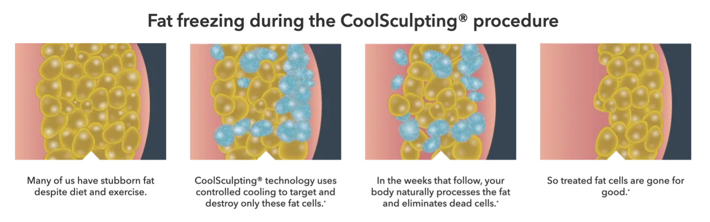 How CoolSculpting Works Singapore