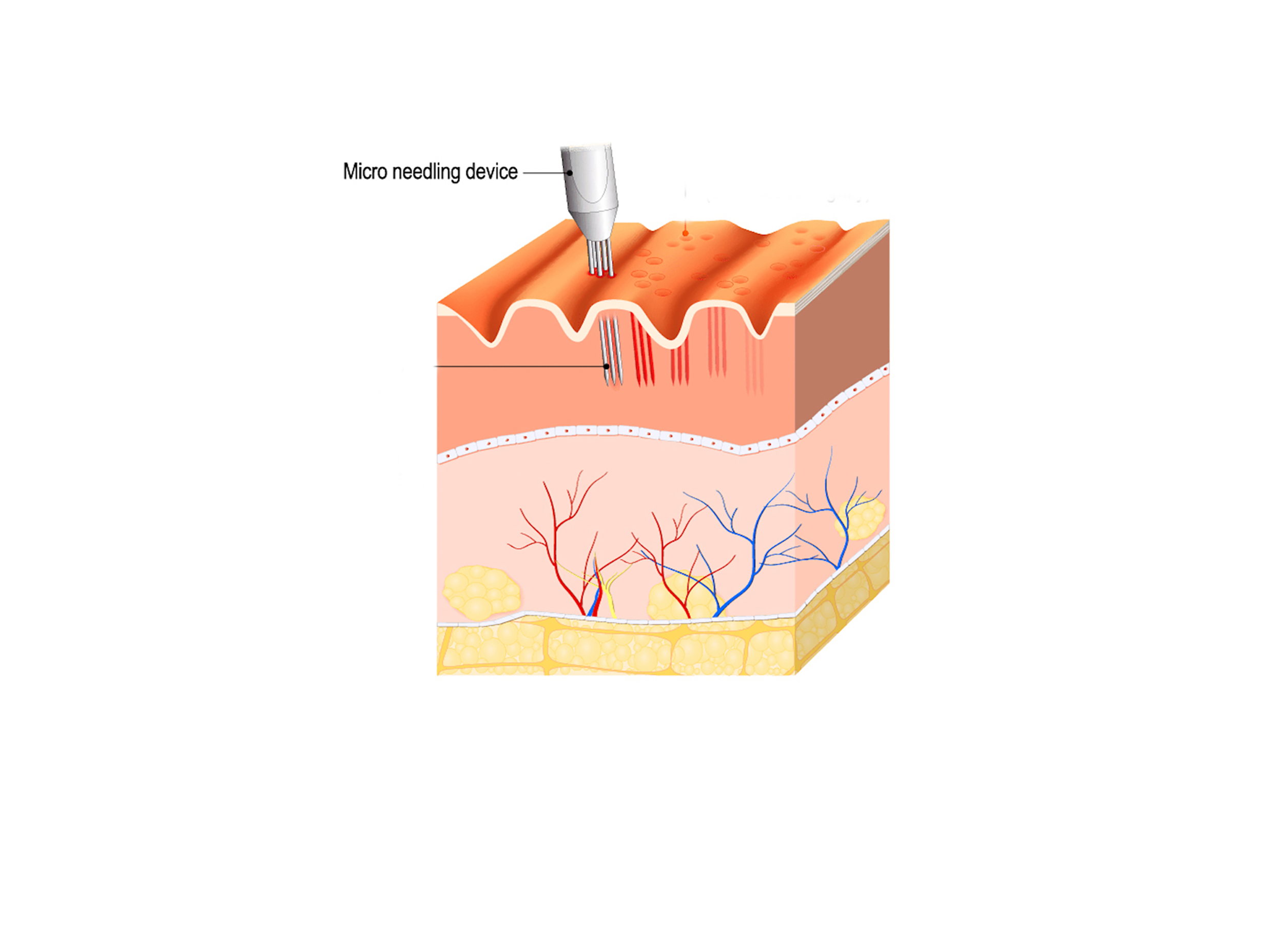 What is microneedling Singapore Halley Medical Aesthetics