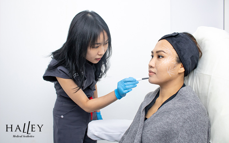 Halley Medical Aesthetics preparing for filler injections to enhance natural facial balance