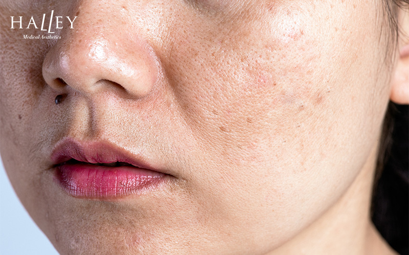 Close-up of uneven skin texture with large pores and wrinkles.