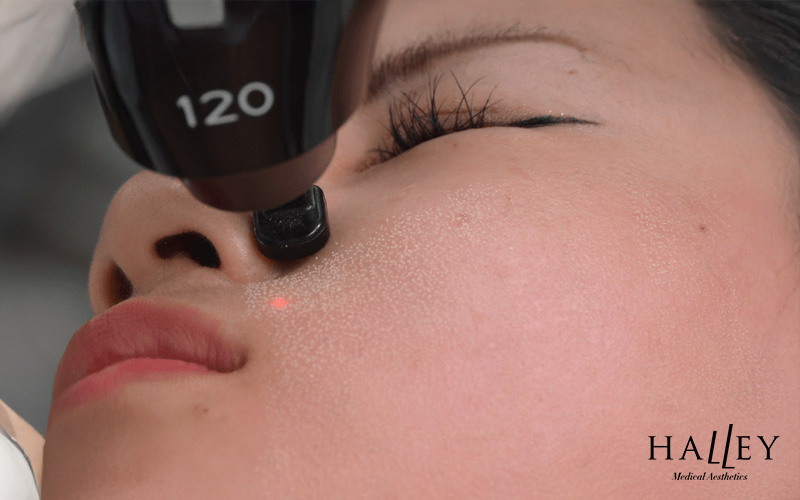Image of fractional co2 laser treatments
