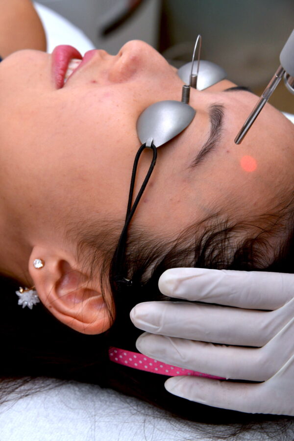 Long pulsed laser acne treatment Singapore