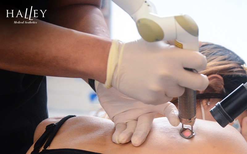 A doctor performing laser tattoo removal on a client's back.