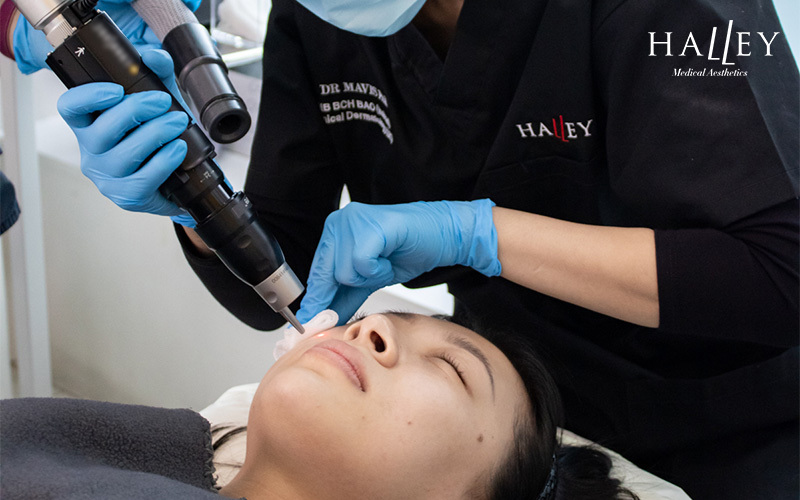 Pico laser treatment medical procedure