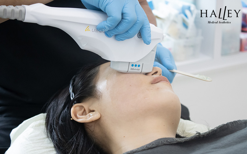 Practitioner using Ultraformer III device on patient’s cheek and jawline during non-invasive aesthetic procedure.