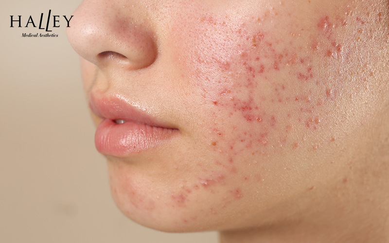 A close-up of a person's face with severe active acne and redness.
