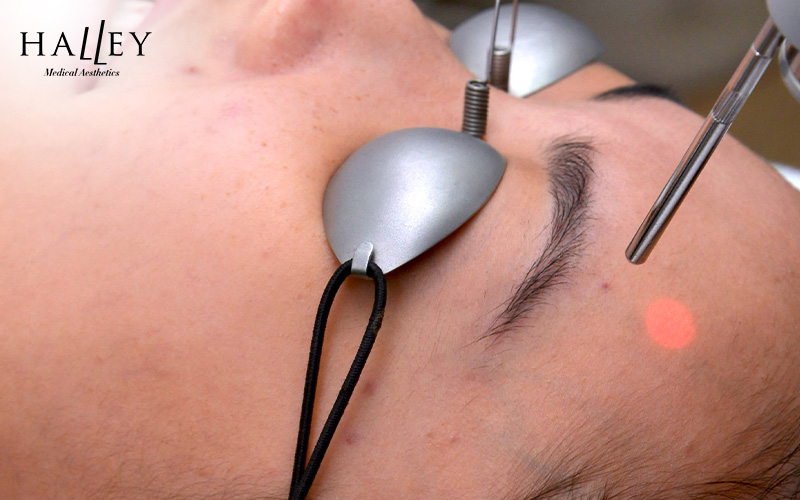 A patient receiving laser treatment for acne.