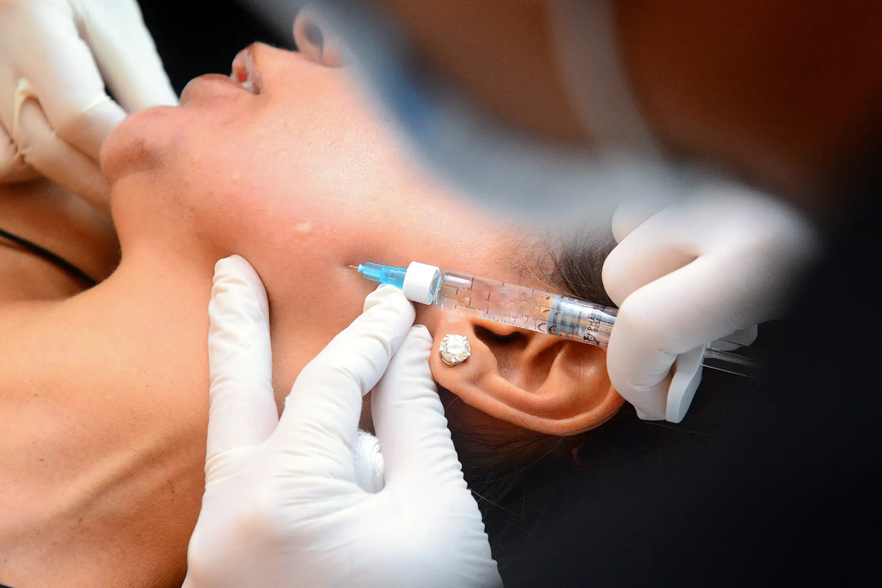 Rejuran Healer Treatment 02