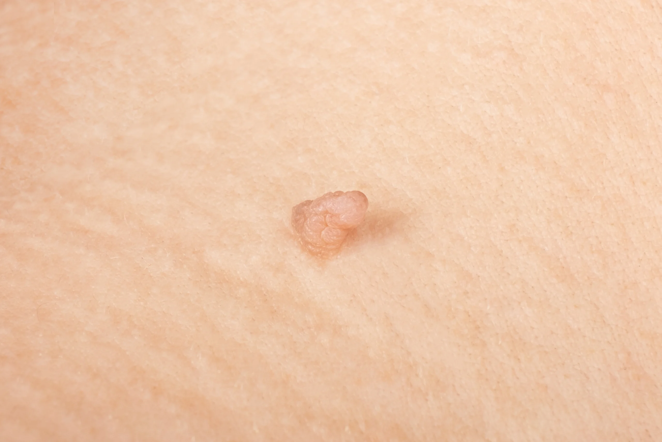 Skin tags