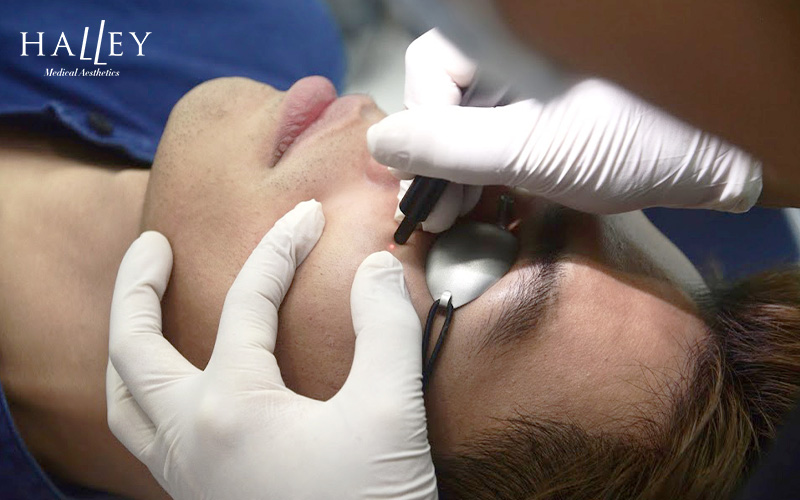 A patient receiving laser treatment for milia