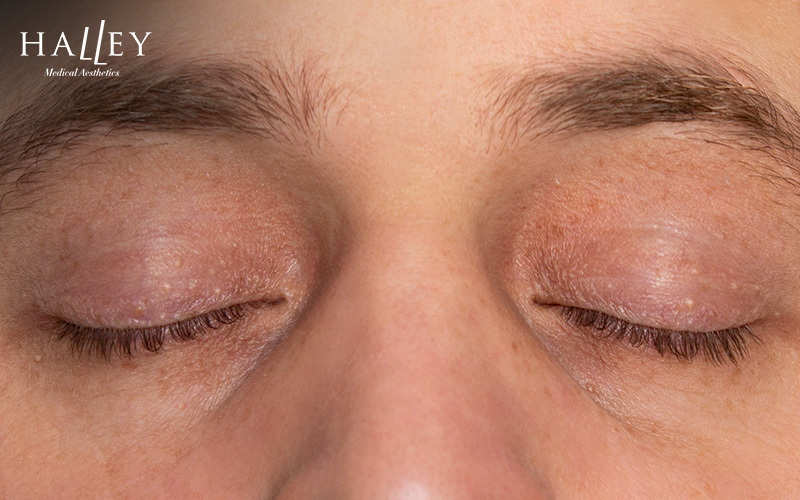 Close-up of eyes showing milia bumps on the eyelids.