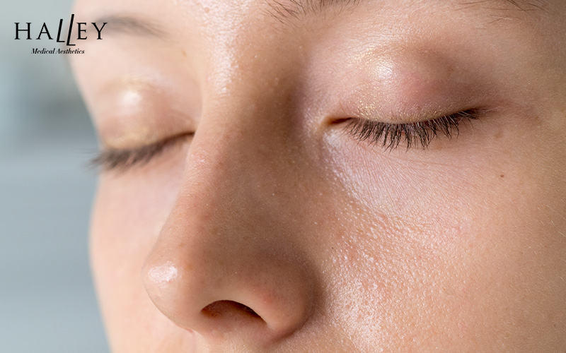 Close-up of eyes showing milia bumps on the eyelids
