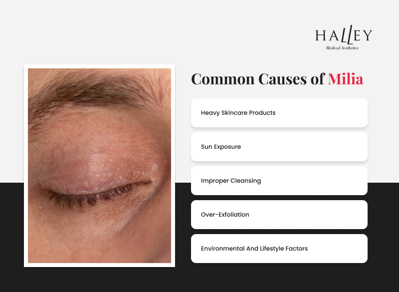 Infographic on common causes of milia