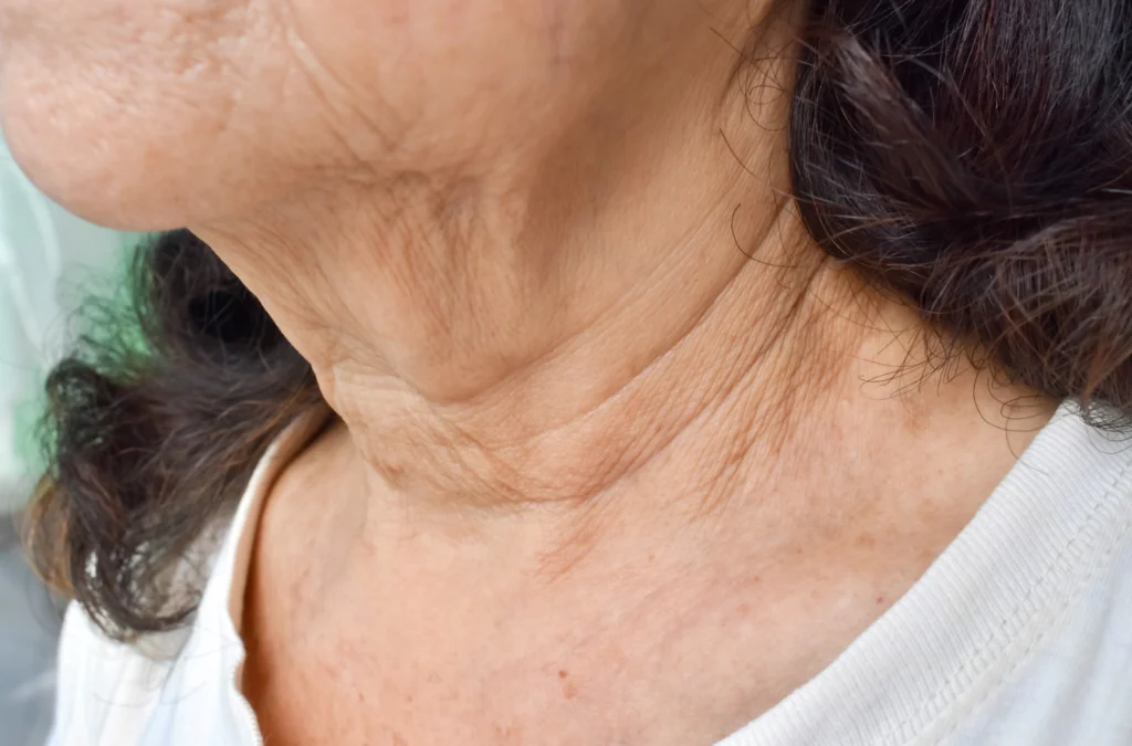 Sagging skin and loss of definition