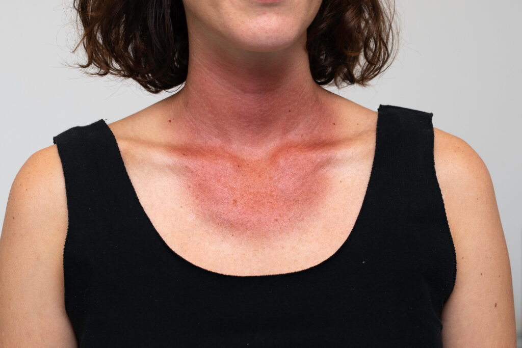 Neck pigmentation