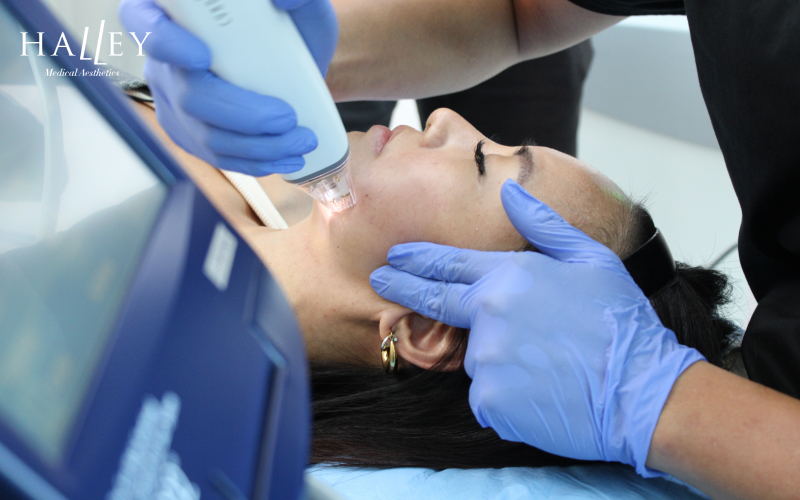 Patient receiving Potenza microneedling treatment at Halley Medical Aesthetics.