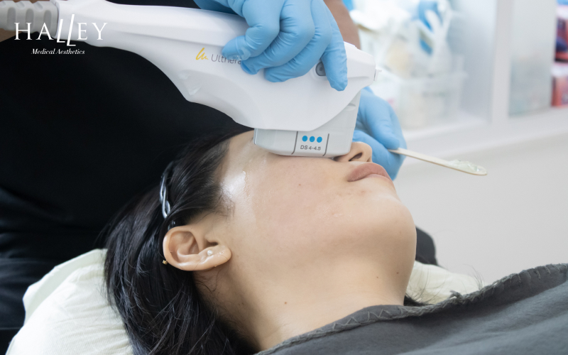 Ultherapy skin tightening treatment performed at Halley Medical Aesthetics.