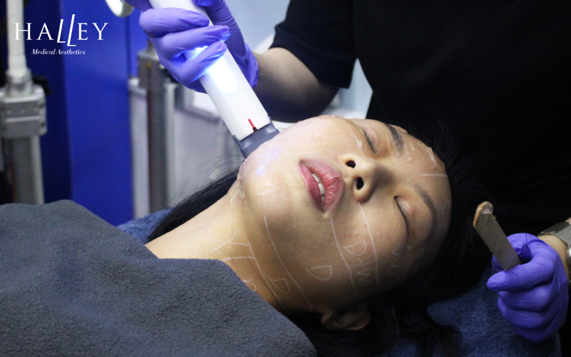 Halley Medical Aesthetics doctor performing Fotona 4D laser treatment.