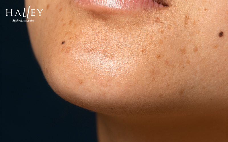 Close-up of facial skin displaying common signs of freckles.