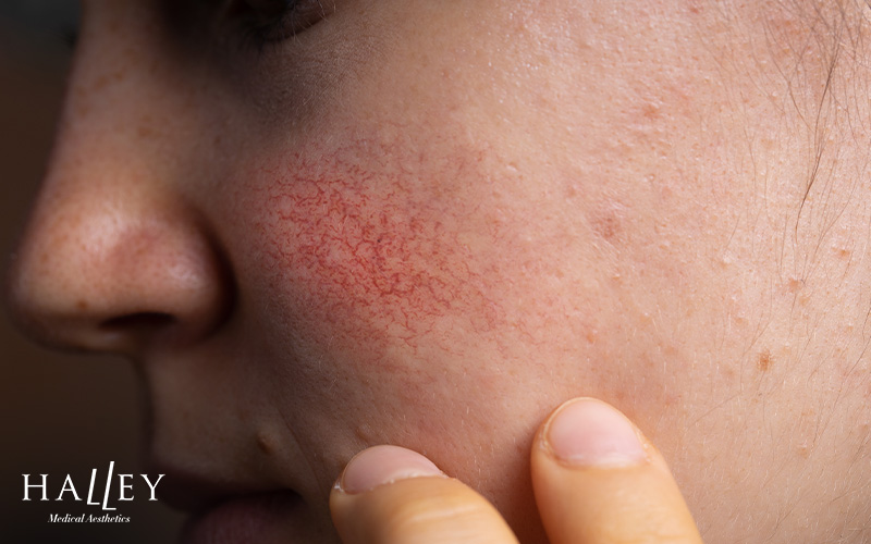 Close-up of facial spider veins on a patient's cheek.