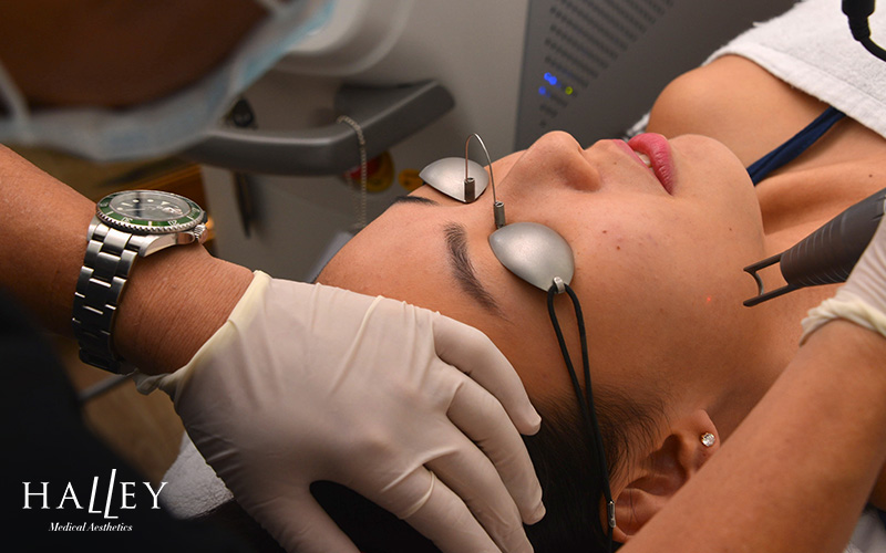 Patient receiving laser treatment for facial spider veins at Halley.