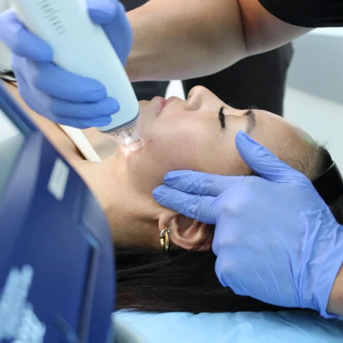 09-Potenza-RF-Microneedling-scaled