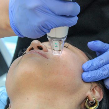 A doctor performing microneedling with RF